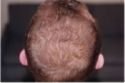 propecia baldness