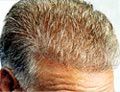 stop hair loss with propecia