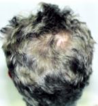 baldness hair lasercomb loss propecia